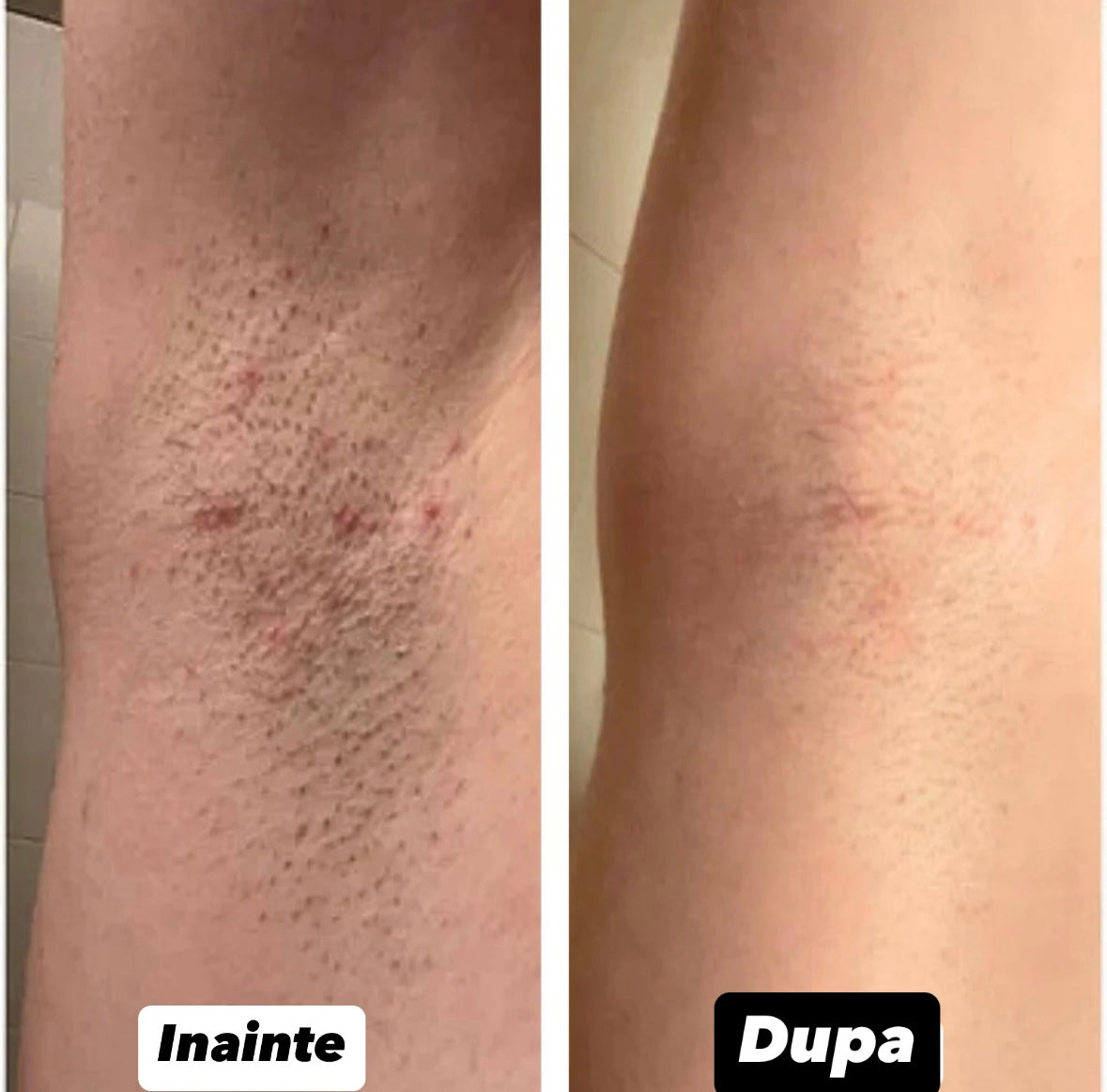 Epilator cu LASER 2.0