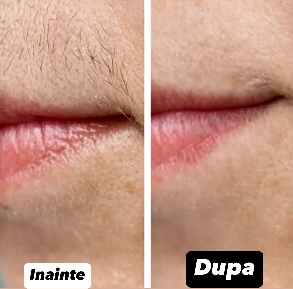 Epilator cu LASER 2.0