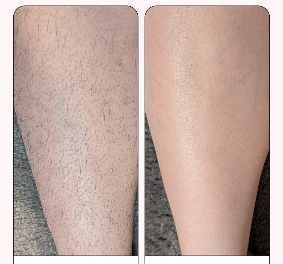 Epilator cu LASER 2.0