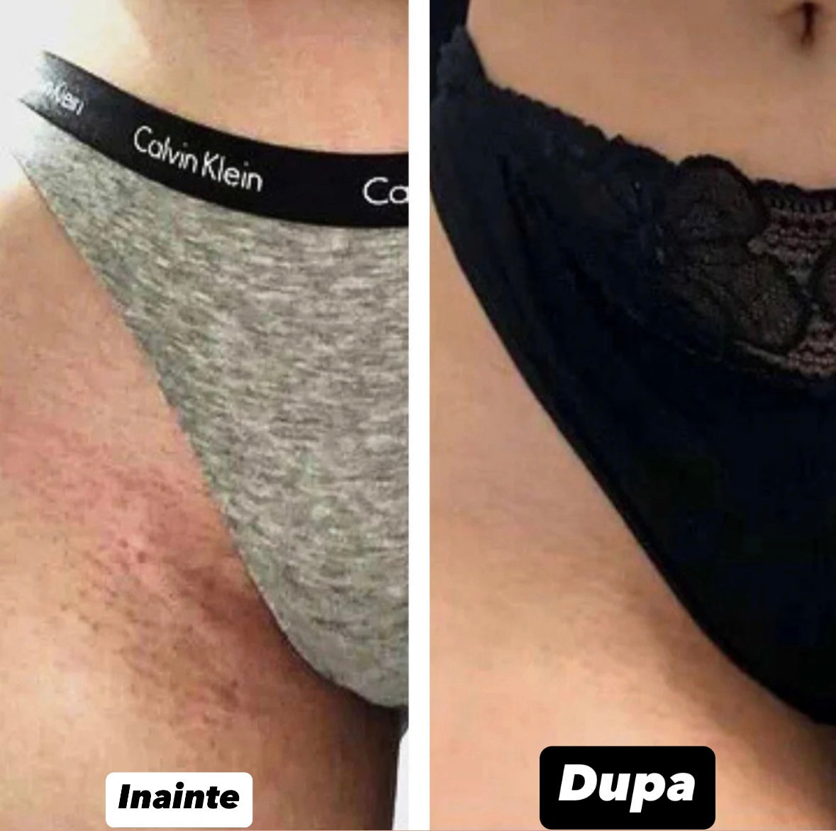 Epilator cu Laser