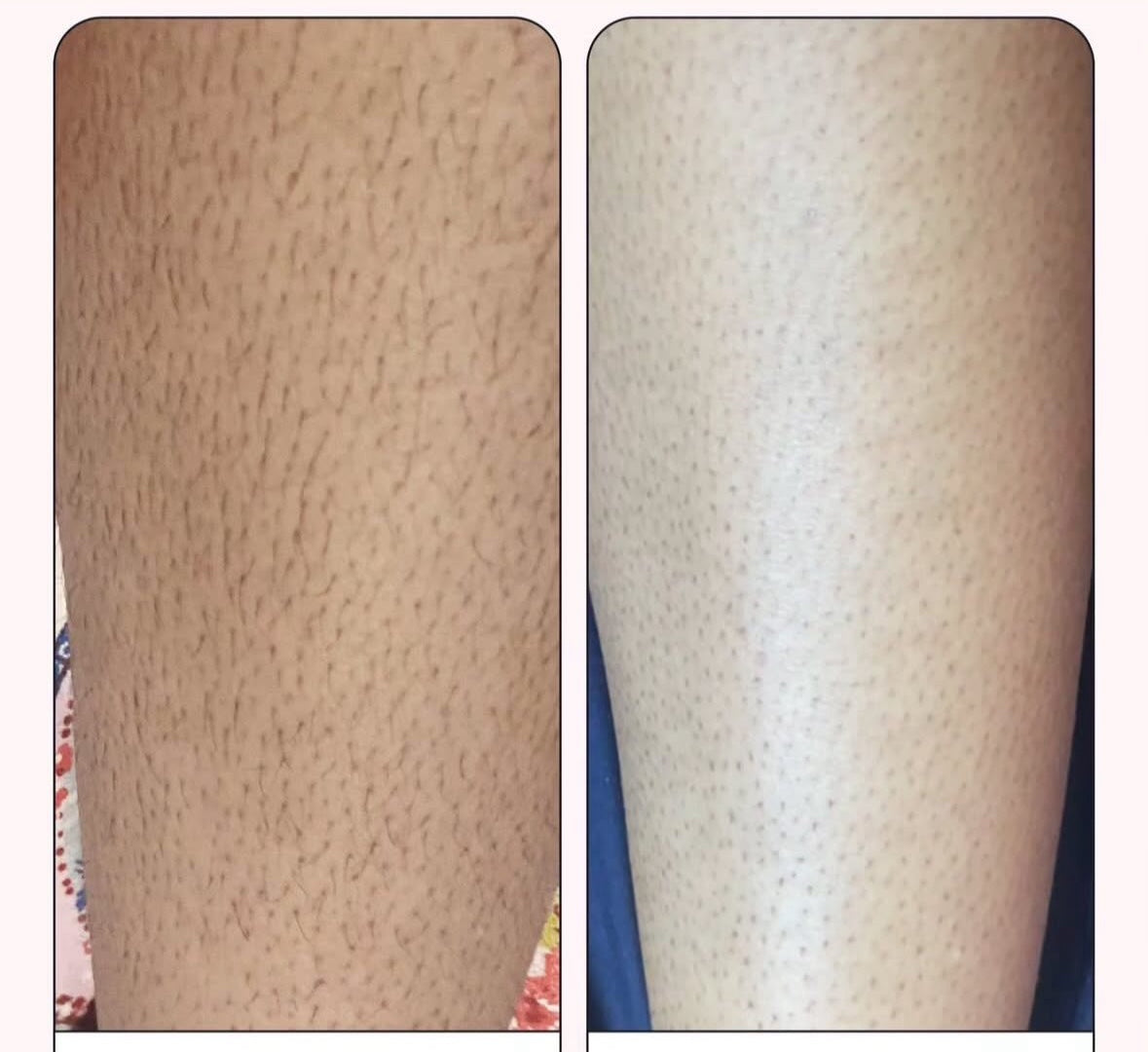 Epilator cu LASER 2.0