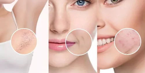 Epilator cu LASER 2.0